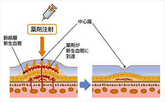 加齢黄斑変性 | 名古屋市天白区で眼科ならみずたに眼科へ