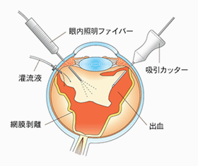 糖尿病網膜症 | 名古屋市天白区で眼科ならみずたに眼科へ